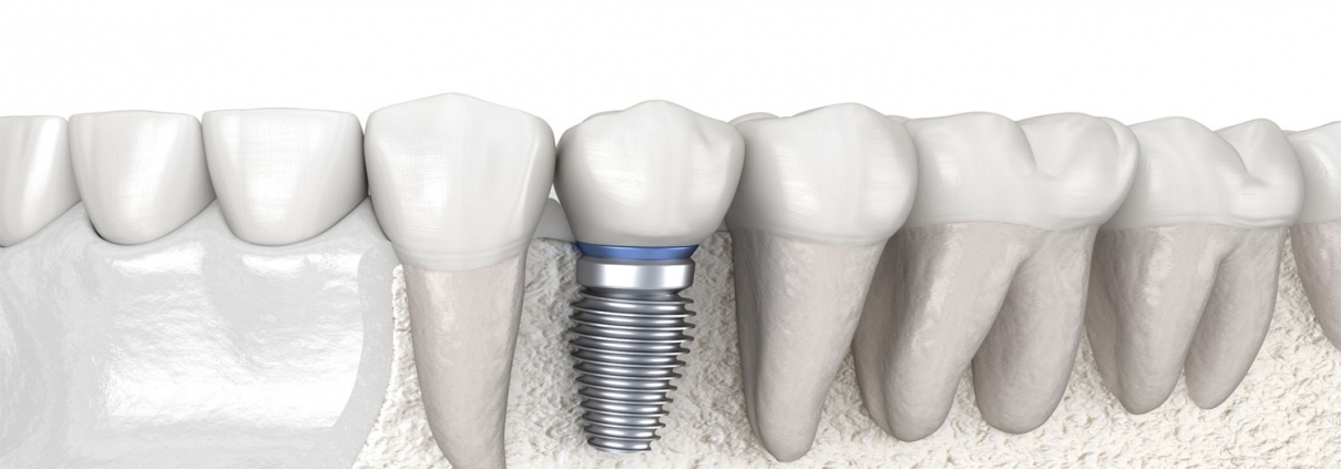 Single Tooth Implant