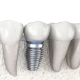 Single Tooth Implant